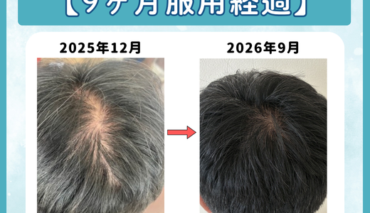 【9ヶ月服用】DMMオンラインクリニックAGAの口コミ評判｜やばい・偽物か独自アンケート延べ85人から調査