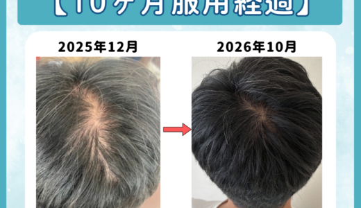 【10ヶ月服用】DMMオンラインクリニックAGAの口コミ評判｜やばい・偽物か独自アンケート延べ85人から調査